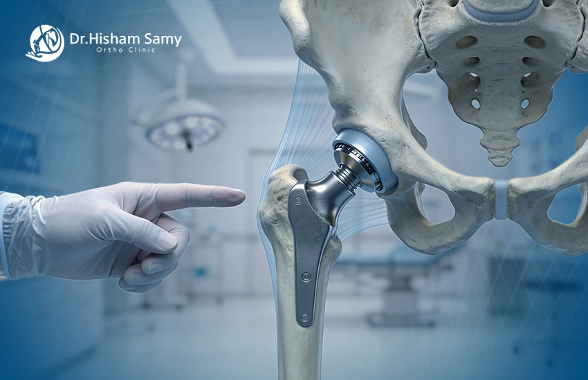 عملية تغيير مفصل الفخذ عملية تغيير مفصل الفخذ