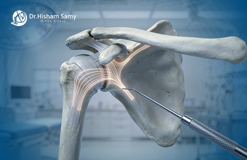 عملية قطع وتر الكتف بالمنظار