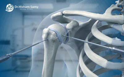 عملية منظار الكتف