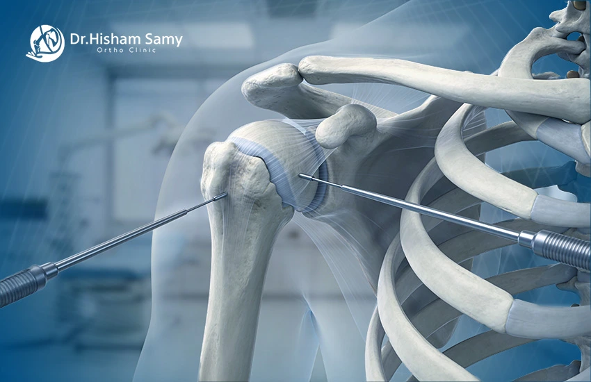 عملية منظار الكتف