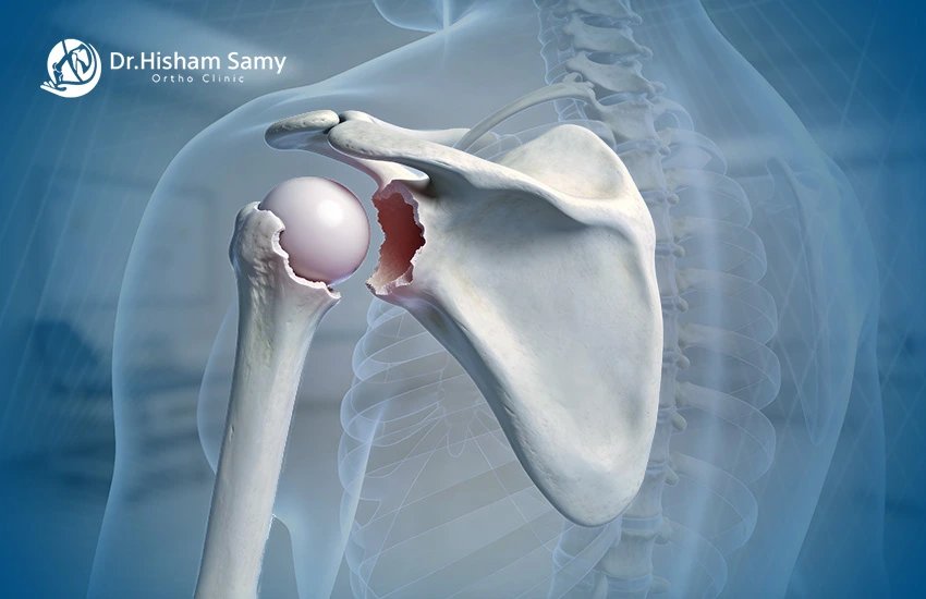 هل الجراحة هي الحل الوحيد لـ علاج خلع الكتف؟