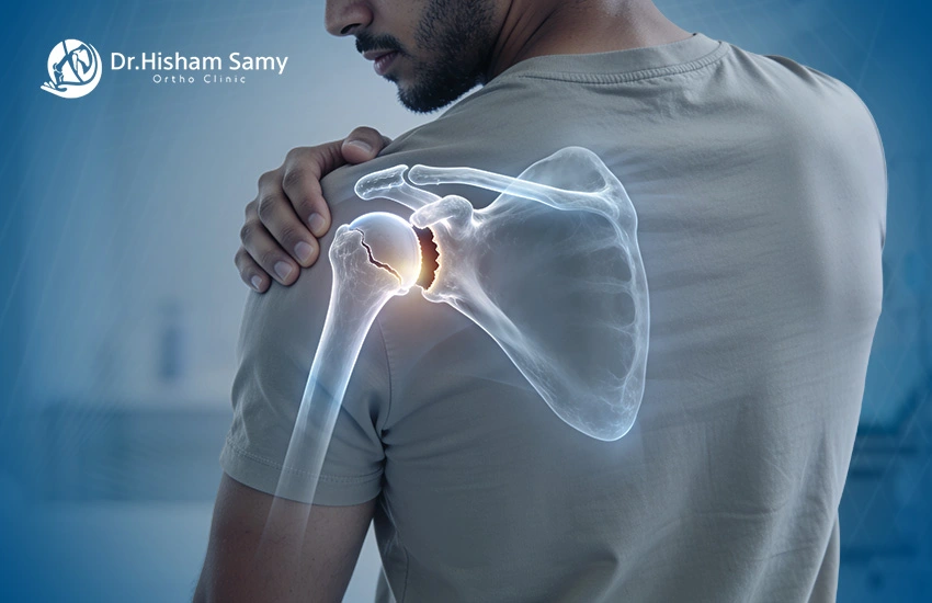 خلع-الكتف خلع الكتف